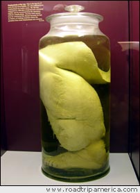 Leg with elephantiasis